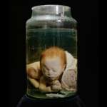 bebe deforme dans du formol