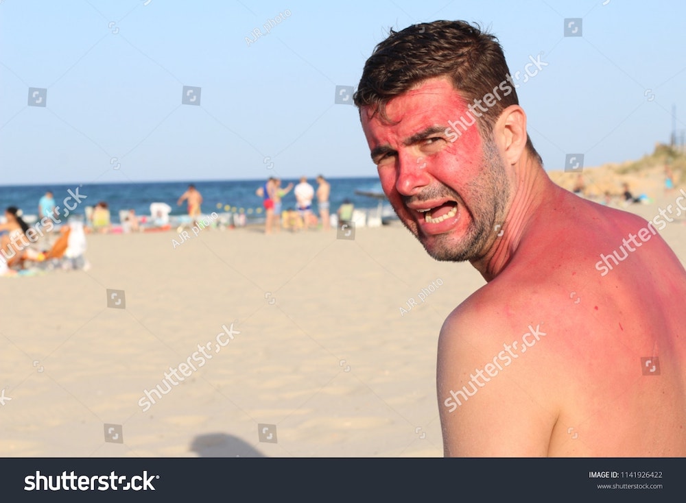 un homme avec des coups de soleil