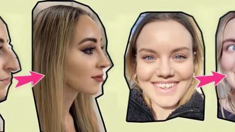 Photos d'avant-après de deux femmes pour le nez puis les dents