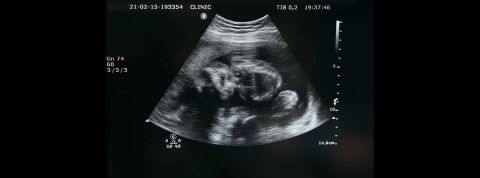 Une startup veut cultiver des embryons humains pour répondre à la pénurie d’organes Echographie