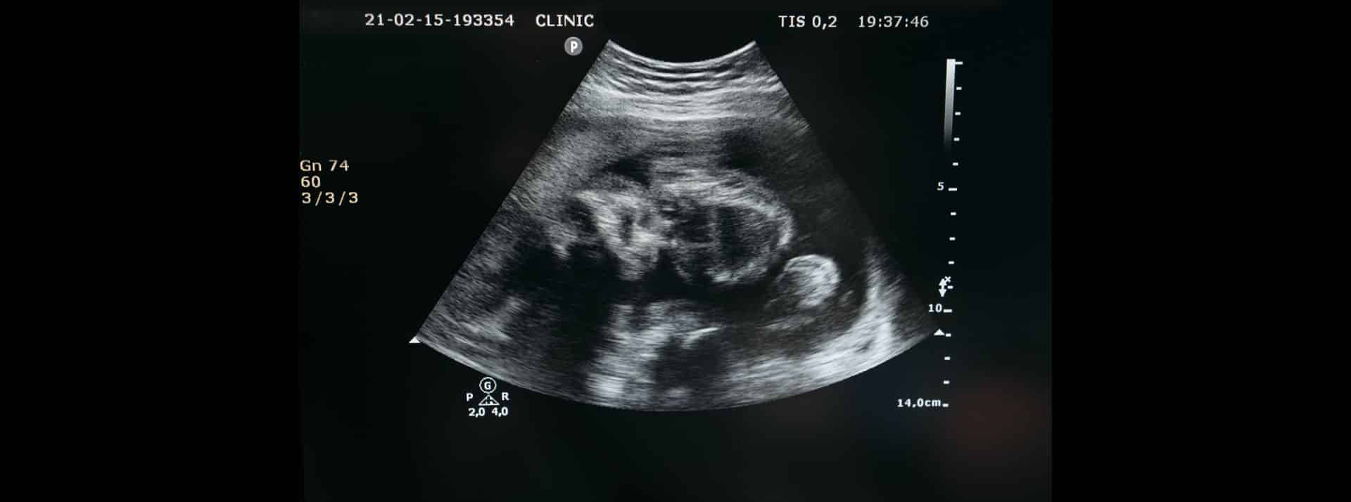 Une startup veut cultiver des embryons humains pour répondre à la pénurie d’organes - L'ADN Echographie