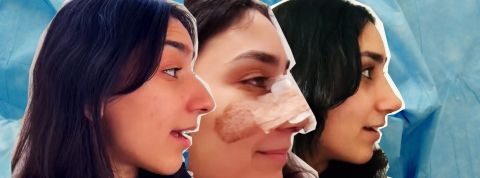 nez-TikTok Une tiktokeuse qui documente son opération du nez.