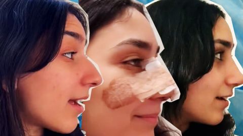 Une tiktokeuse qui documente son opération du nez.